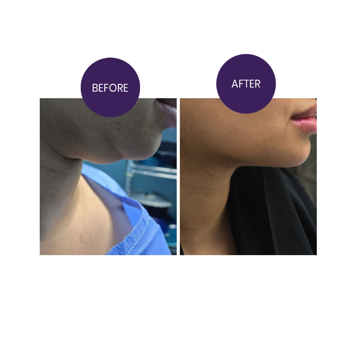 Double Chin Correction (Chin Liposuction)