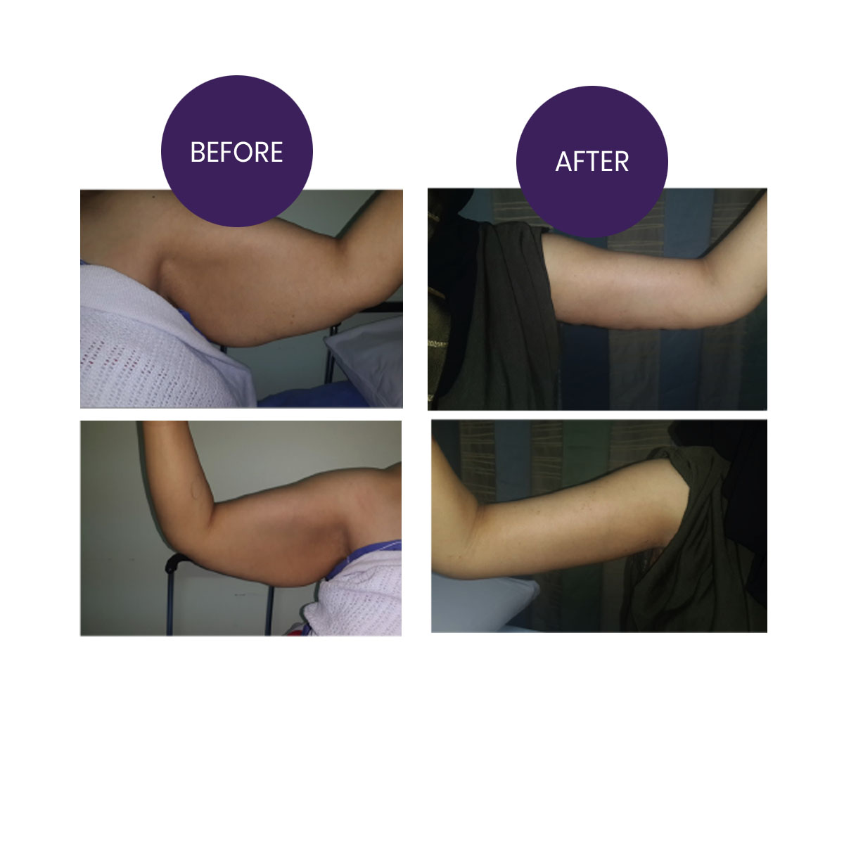 ARM LIFT ( Brachioplasty)