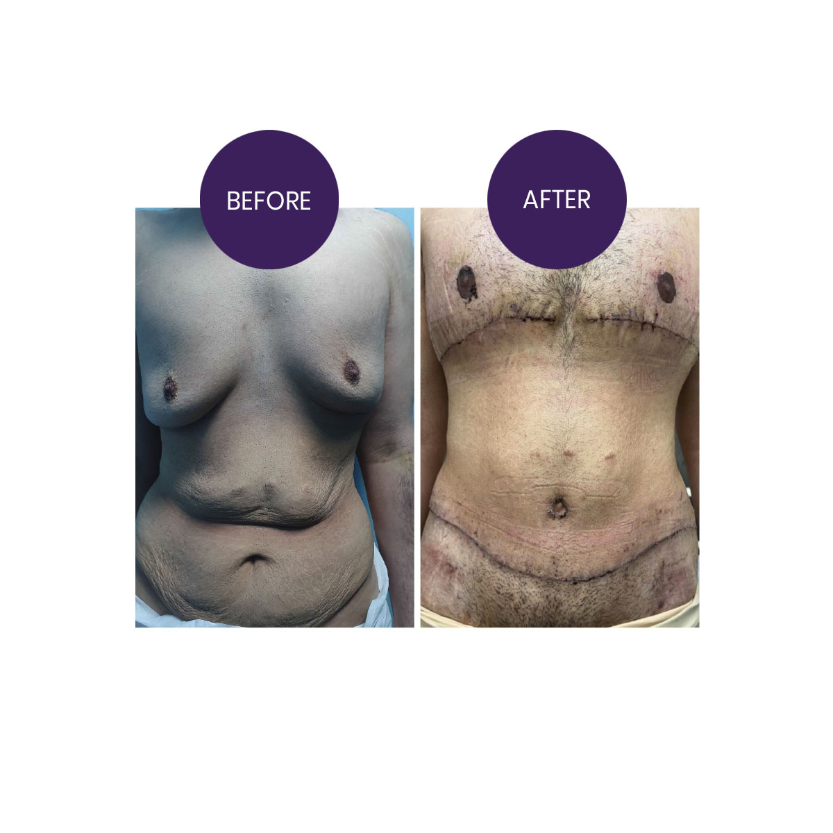 Male Mastopexy