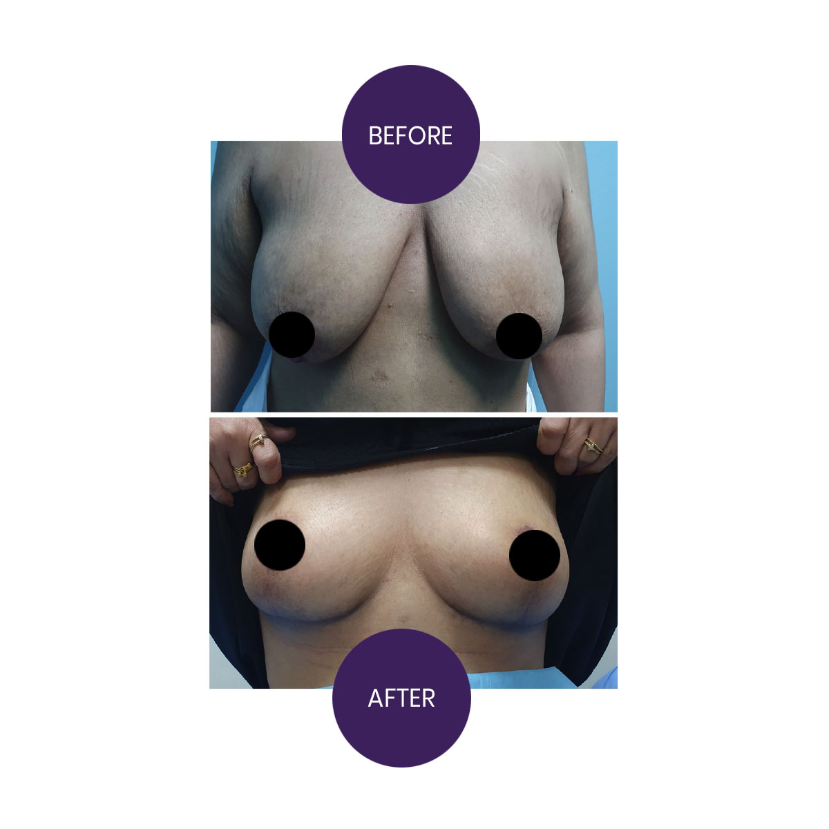 Breast lift (Mastopexy)