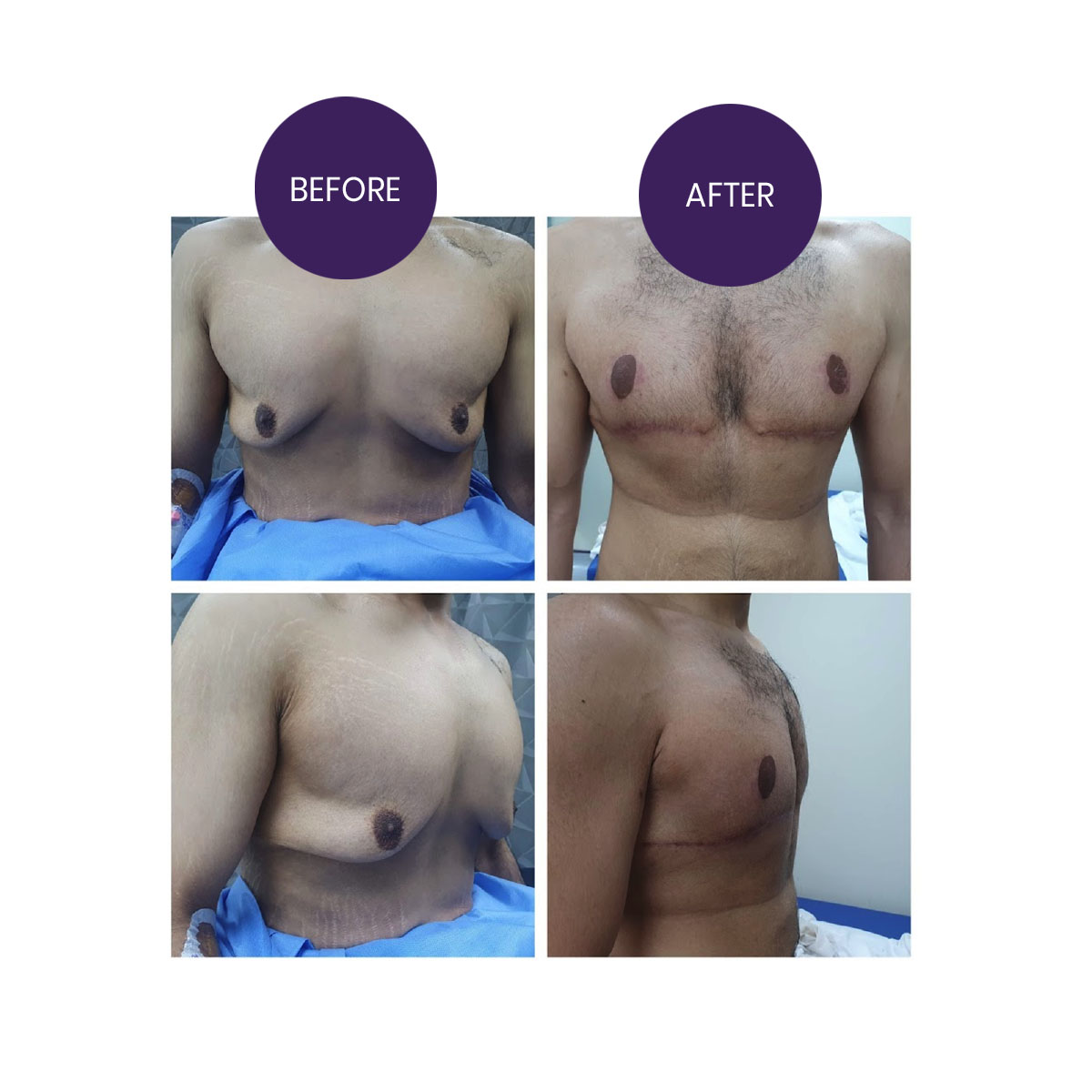 Male Mastopexy