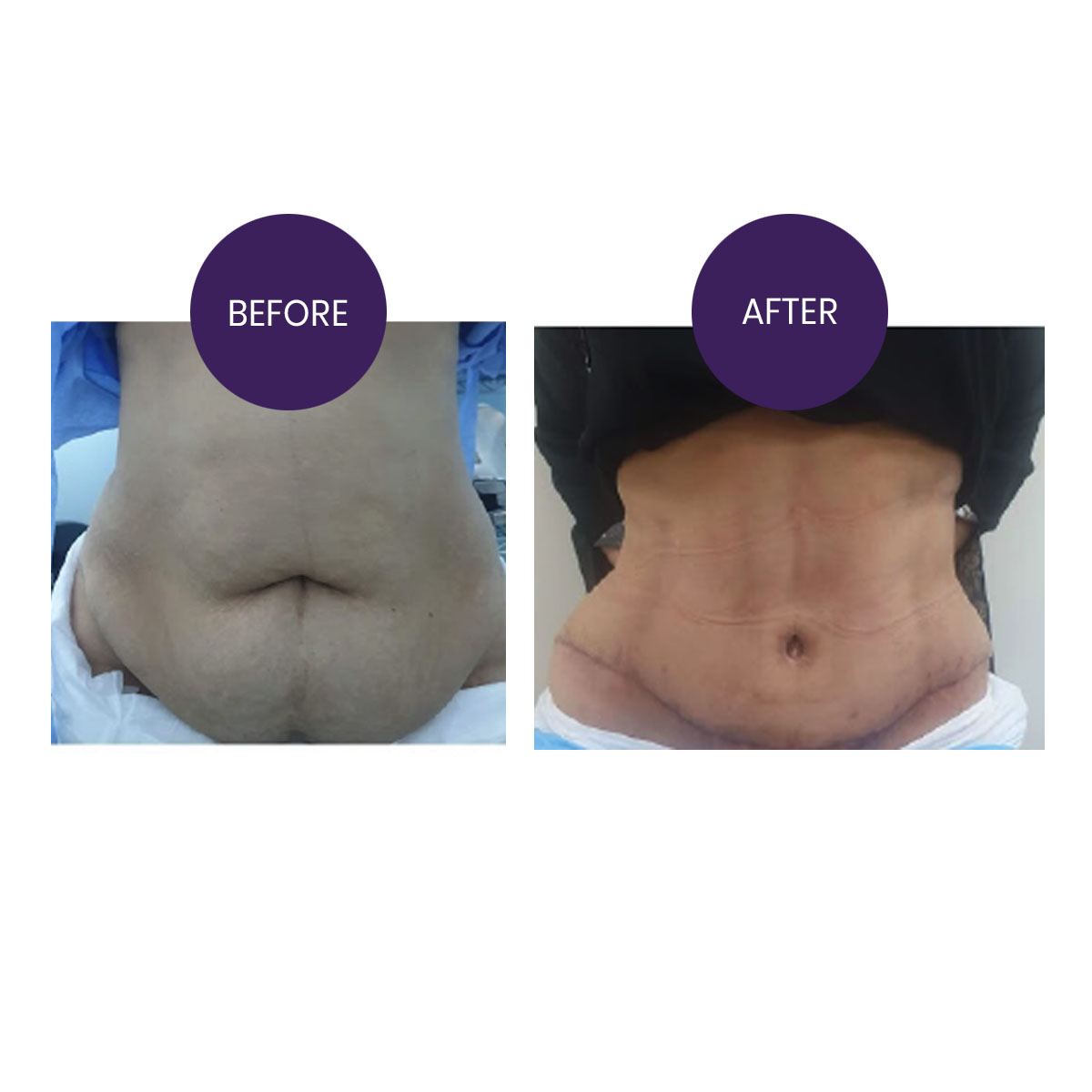 ABDOMINOPLASTY( TUMMY TUCK SURGERY)