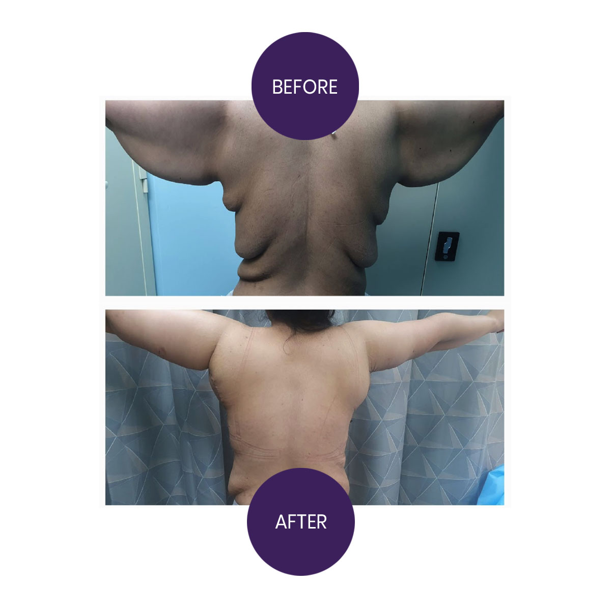 Brachioplasty with lateral thoracoplasty