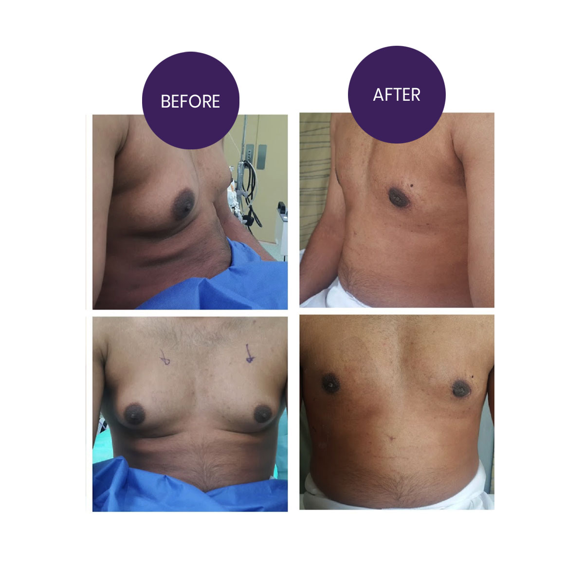 Gynecomastia ( Male breast reduction)