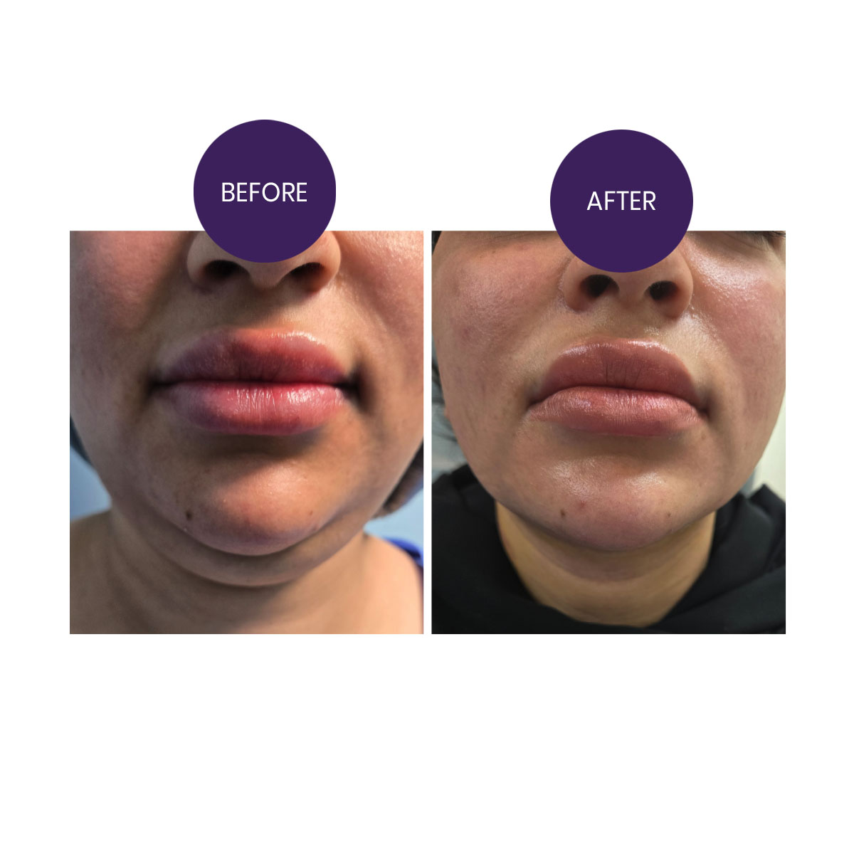 Double Chin Correction (Chin Liposuction)