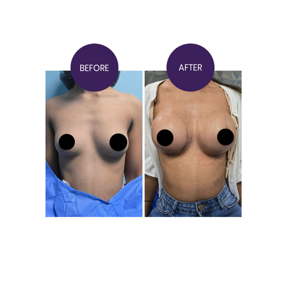 Breast Augmentation